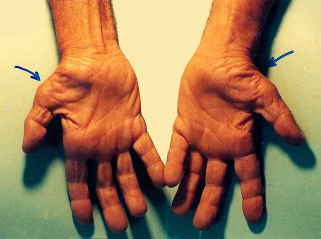 Carpal Tunnel