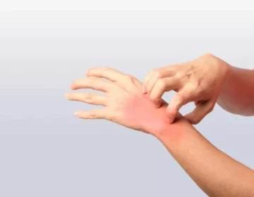 Skin Allergy