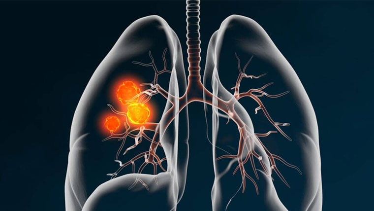 Lungs